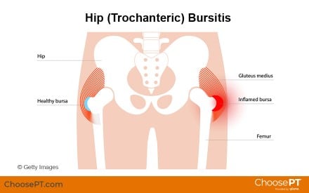 What is Trochanteric Bursitis, symptoms, casuses, treatments & prevention