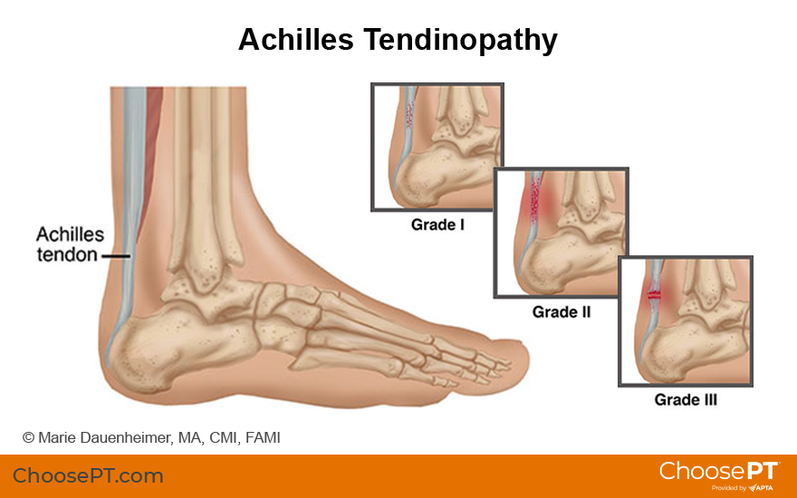 Your Achilles Heel: A Look at Heel Pain While Running - Runner's Tribe
