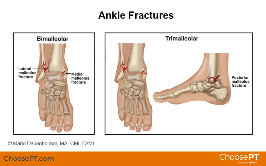 medial malleolus fracture