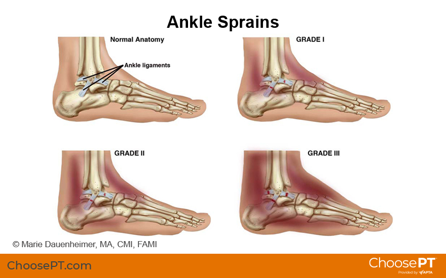 Lateral Ankle Sprain: Home Exercise Program For Acute Phase