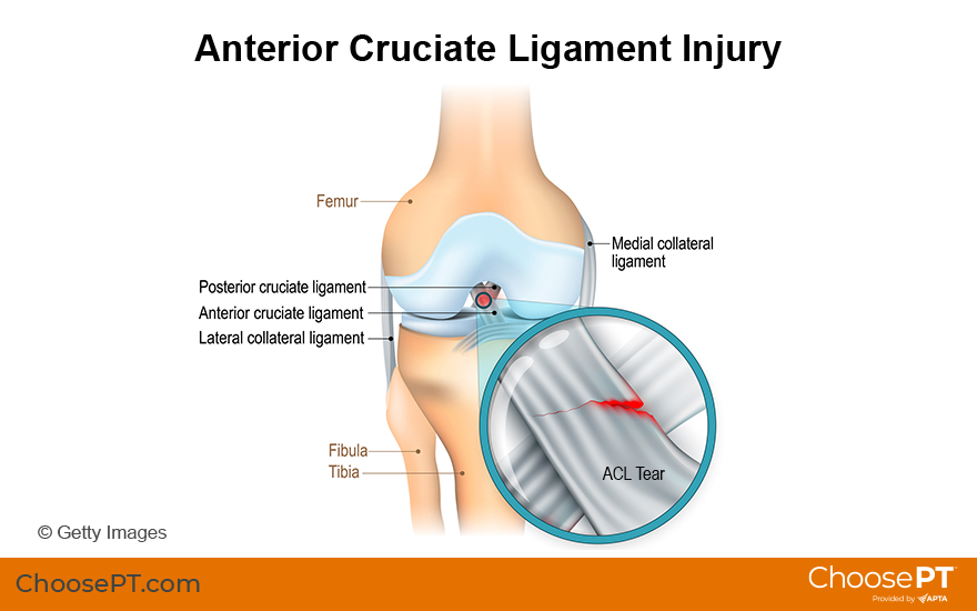 Ligament injuries - Choose physio