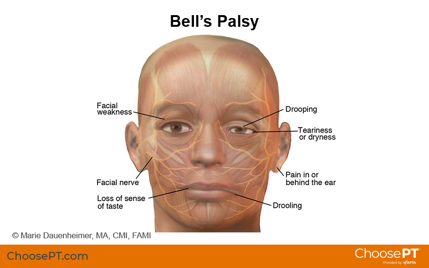 Bells Palsy - Head - Conditions - Musculoskeletal - What We Treat