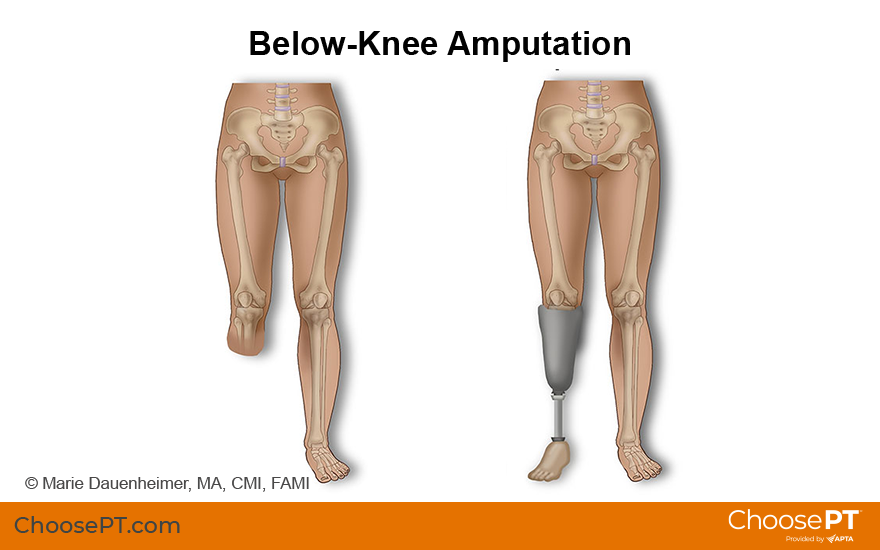 Guide  Physical Therapy Guide to Below-Knee Amputation