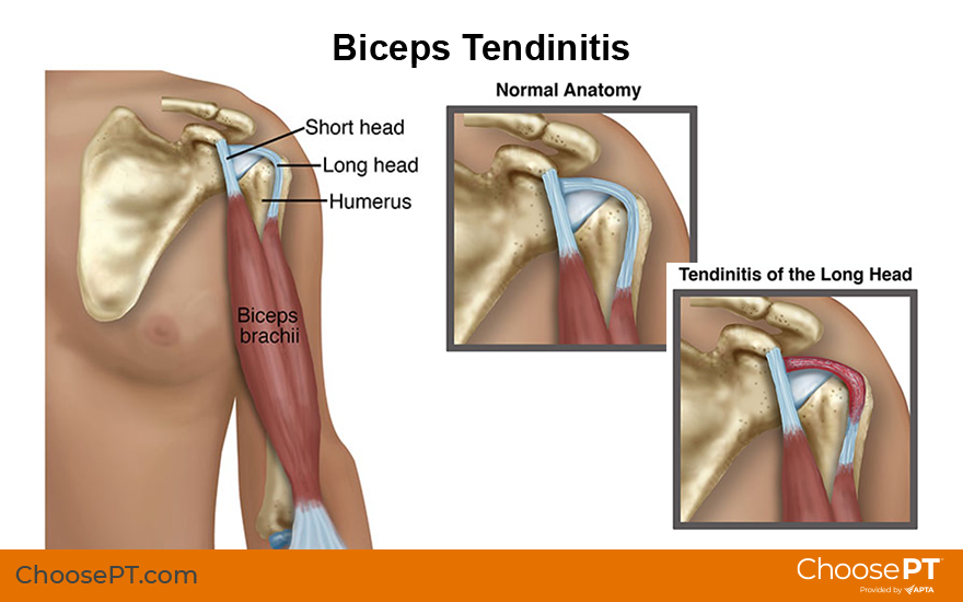 inflamed shoulder tendons