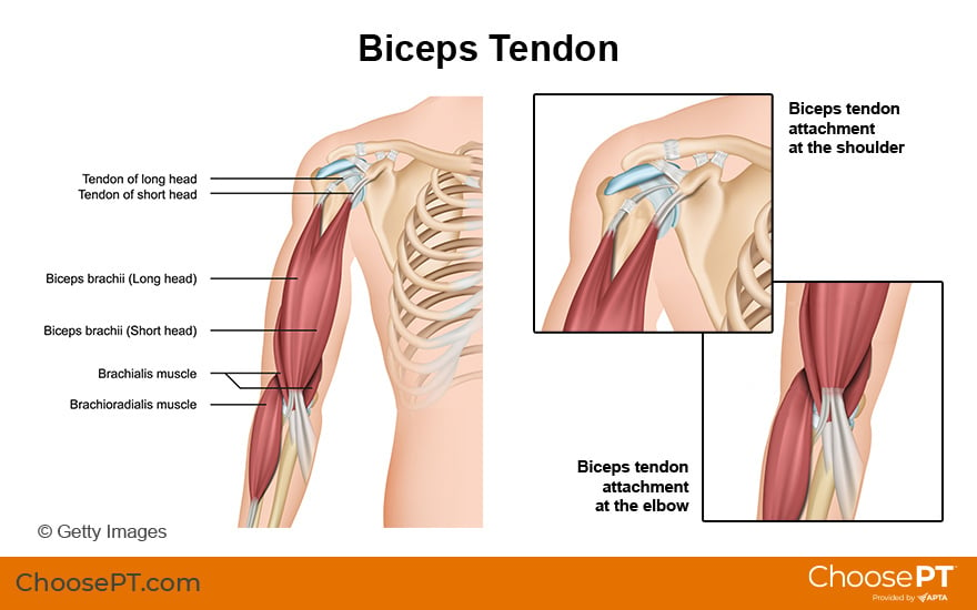 ripped bicep tendon