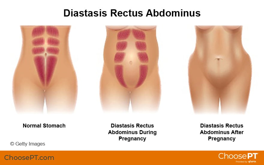 Guide  Physical Therapy Guide to Diastasis Rectus Abdominis