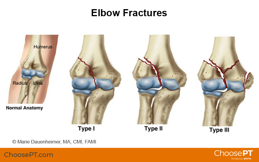 Guide Physical Therapy Guide To Elbow Fracture Choose Pt