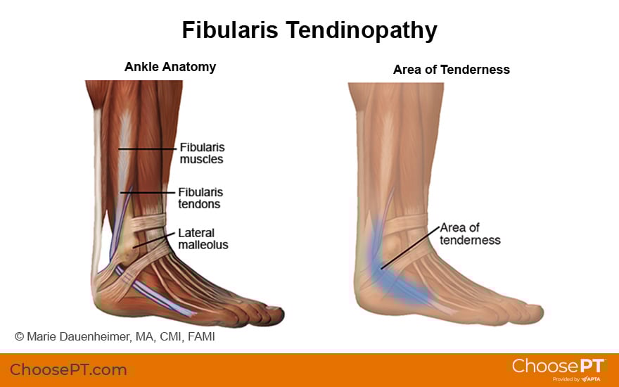Illustration of fibularis tendinopathy