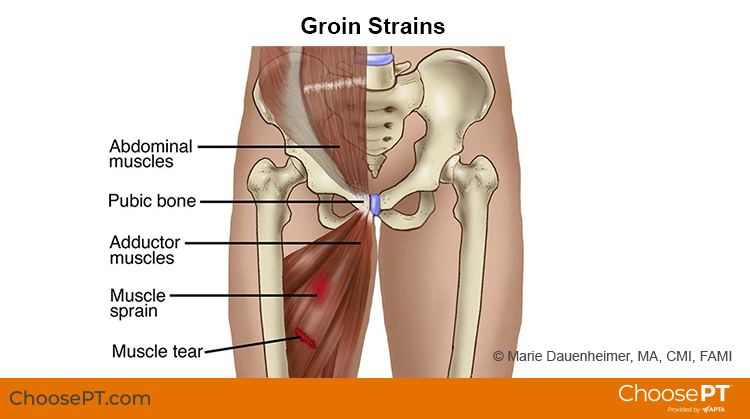 Groin Strain and Injury