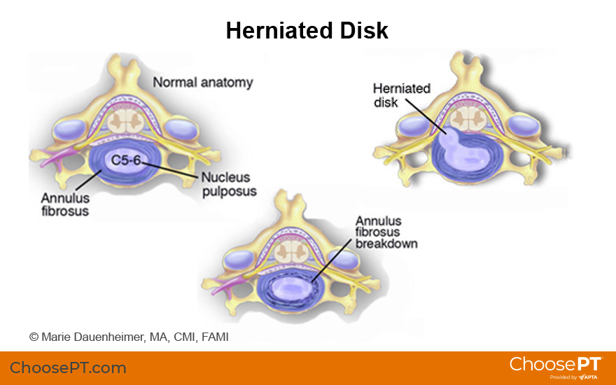 Herniated Disc  Symptoms & Advanced Spine Care