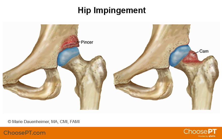 Therapy Guide to Impingement (Femoroacetabular Impingement) - Carousel Physical Therapy