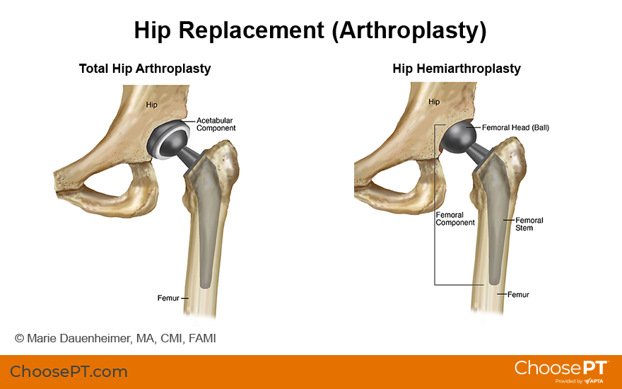 Hip joint replacement Information