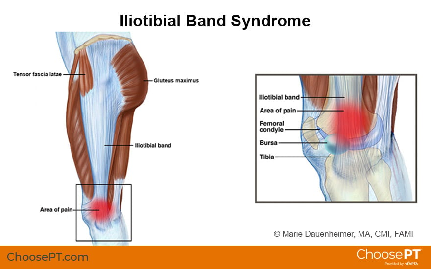 Physical Therapy in our clinic for Knee - Iliotibial Band Syndrome