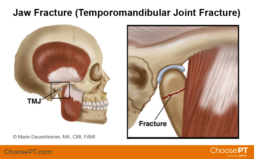 Guide Physical Therapy Guide To Jaw Fracture Temporomandibular Joint 