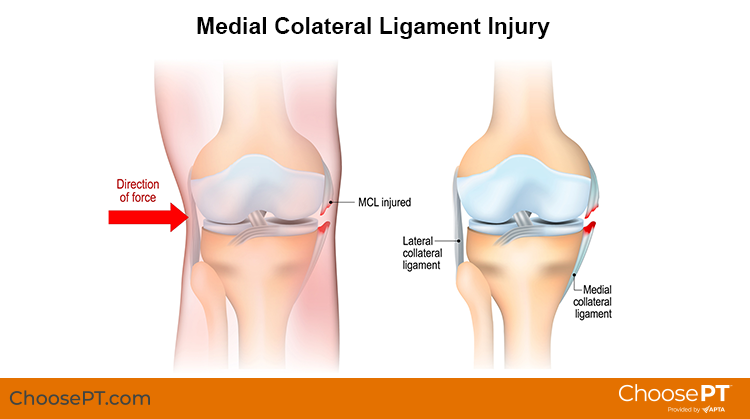Medial Collateral Ligament (MCL) Tear Midtown East NY : Comprehensive PT  Associates