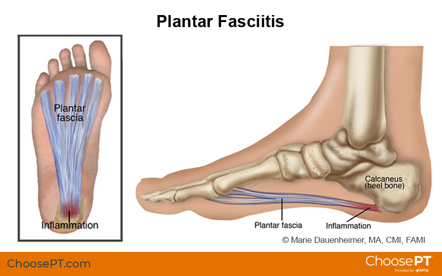 Plantar Fasciitis: Treatment by a Physical Therapist 