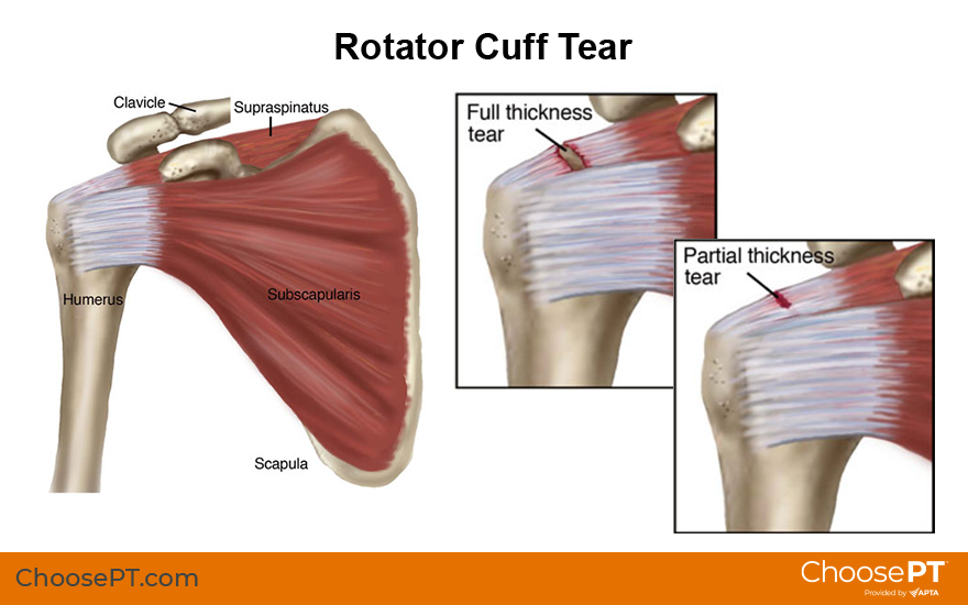 Rotator Cuff Disorders: The Facts - OrthoBethesda