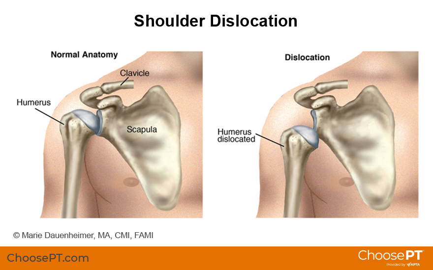 Shoulder Dislocation  Causes, Symptoms, Treatment & Braces