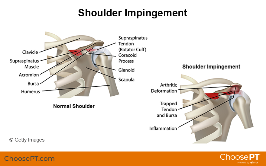 top of left shoulder pain