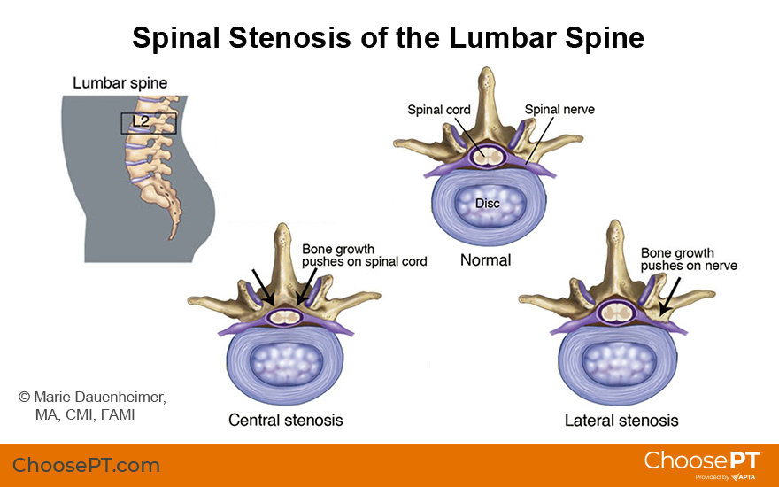 Guide, Physical Therapy Guide to Spinal Stenosis