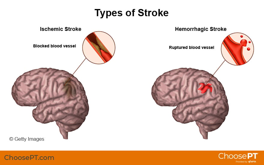 Which Side to Face Bed, Chair and Place Objects After Stroke for  Occupational Therapy – OT Dude