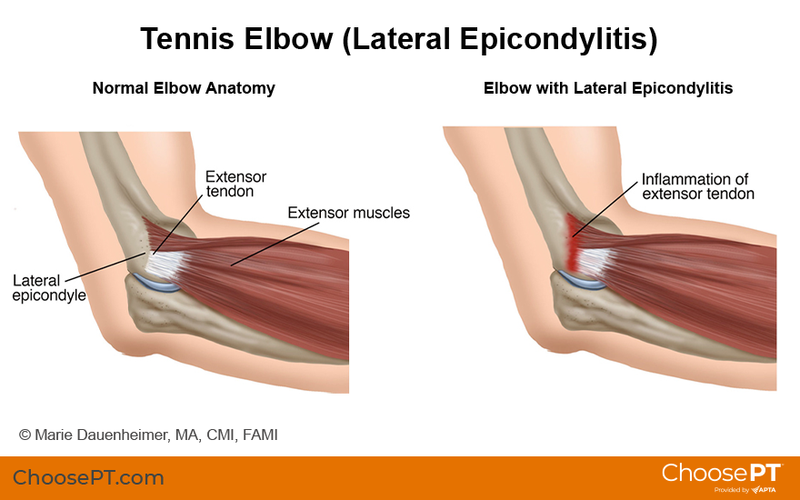 tennis elbow injection