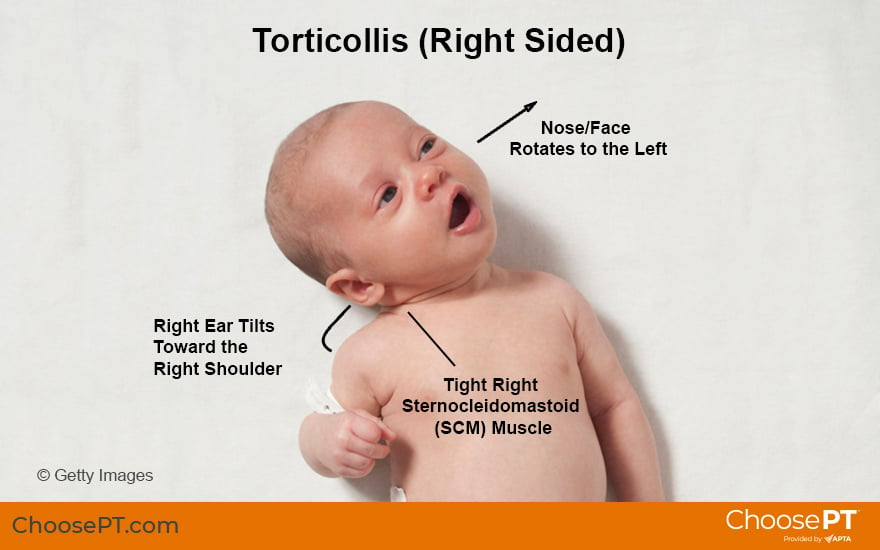 Guide Physical Therapy Guide To Torticollis Choose Pt